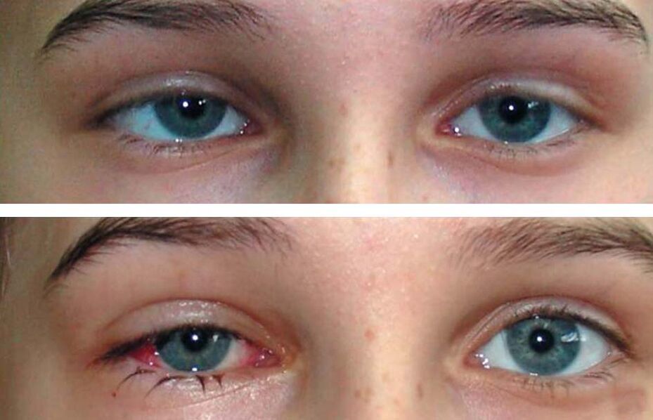 Vor und nach der Behandlung Oculax